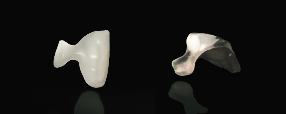 詰め物(インレー)